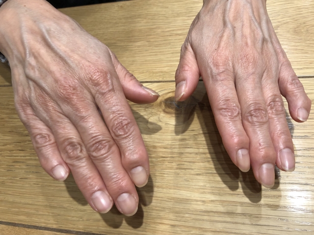 へバーデン結節　福岡